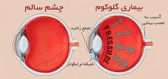 اسلاید آموزشی با عنوان گلوکوم،اثرات بیماری های سیتمیک بر چشم