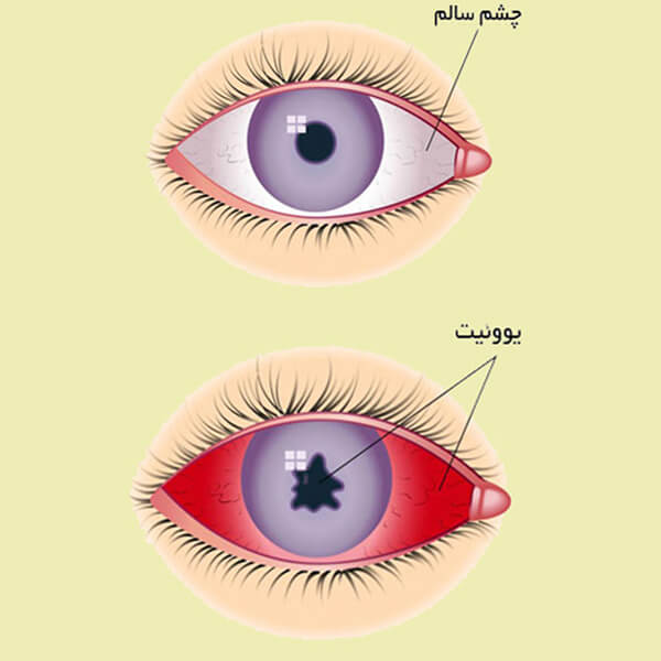 دانلود پاورپوینت معرفی بیماری یوئیت چشم