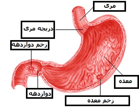 پاورپوینت درباره زخم پپتیک  peptic ulcer